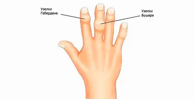 Заболевания суставов кистей рук | АВАР НКО | Дзен