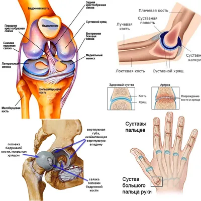 Артроз суставов - лечение, степени, симптомы, причина, профилактика,  признаки, стадии