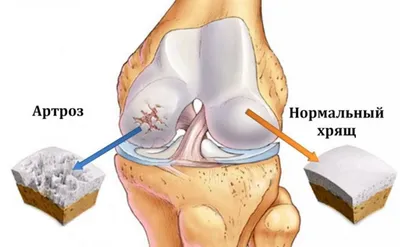 Артроз - симптомы, диагностика, лечение | Медицинский центр ДА!