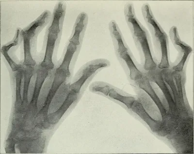 Что нужно знать о полиартрите пальцев рук - YouTube