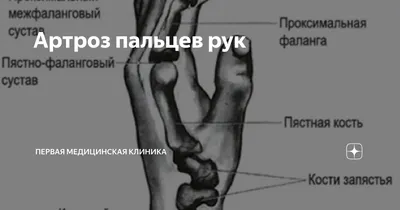 Артроз пальцев рук | Первая Медицинская Клиника | Дзен