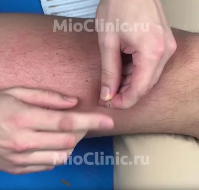 Что такое артроз коленного сустава лечение и симптомы, как лечить артроз  колена | MioClinic