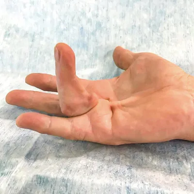 Лечение артроза пальцев рук. Как лечить деформирующий, посттравматич� | все  для здоровья | Постила