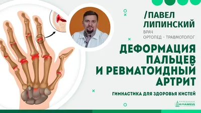 Деформация пальцев и ревматоидный артрит. Гимнастика для здоровья кистей |  Павел Липинский - YouTube