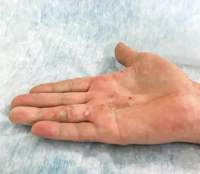Артроз пальцев рук: причины, симптомы, лечение.