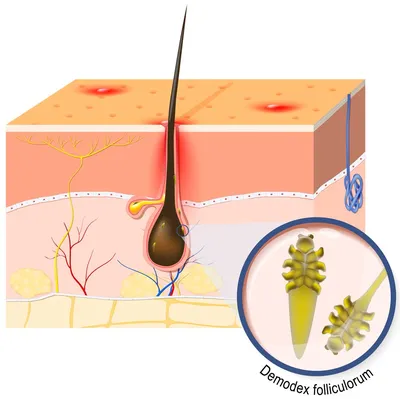 Демодекоз волос головы у человека – схема лечения, шампуни, симптомы и  причины