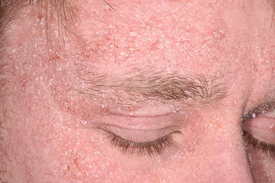Демодекоз волос и век - схема лечения на лице, причины симптомы, шампуни