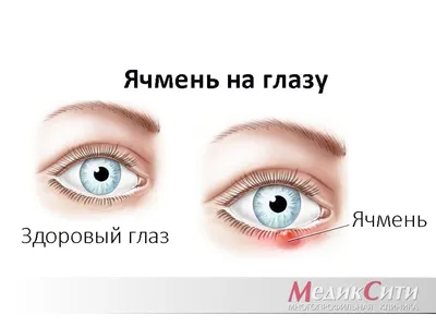 Блефарит: симптомы, причины, лечение этого заболевания глаз. - Всё о зрении.