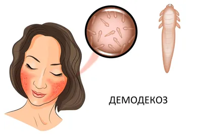 Демодекоз - симптомы, лечение демодекоза век на лице у человека