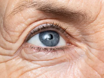 Демодекс глаз или ресничный клещ: методы лечения | ESTET-PORTAL | Дзен