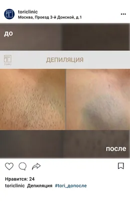 Уход за кожей до и после депиляции | imkosmetik журнал о маникюре и красоте