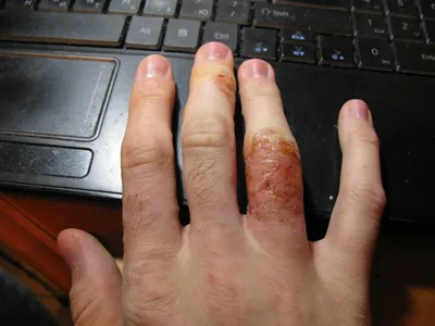 Экзема атопический дерматит симптомом текстуры кожи. Закрыть кожу красными  пятнами стоковое фото ©ternavskaia.o@gmail.com 212510560