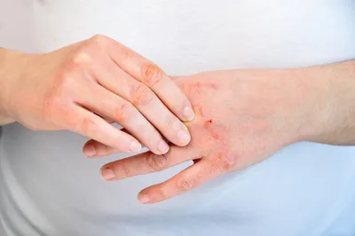 Атопический дерматит и экзема – как взять под контроль болезнь и убрать  высыпания на коже | О здоровье: с медицинского на русский | Дзен