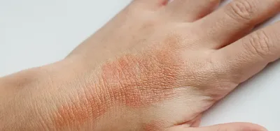 Аллергия, дерматит, экзема 📍Первый признак аллергии на руках это отсутсвие  рогового лоскута - кутикулы. А также сухая и ломкая пластина, … | Instagram