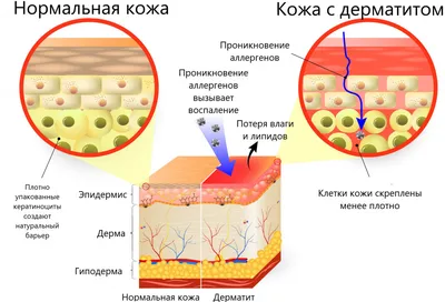 Себорейный дерматит