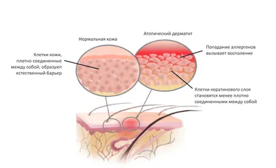 Крем Bioderma ABCDerm Peri Oral - «Лечение периорального дерматита по  назначению дерматолога. Борьба с прыщами в нижней трети лица.» | отзывы