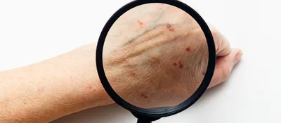 Атопический дерматит: причины и симптомы, лечение, советы дерматологов |  Beauty Insider