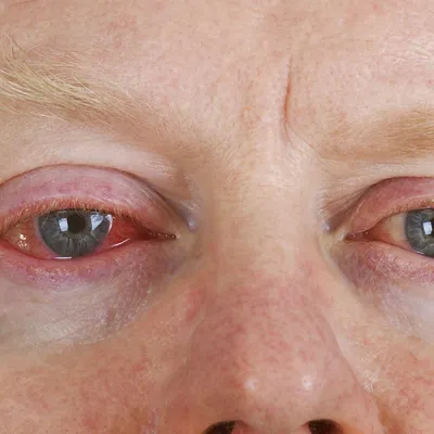 Почему при аллергии страдают глаза? - РКОБ им. проф. Е.В. Адамюка