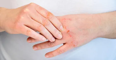 Атопический дерматит, грибок кожи рук и ногтей, что это? - Вопрос  дерматологу - 03 Онлайн