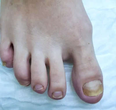 Палец на ногу. Гнойная рана на ноге. Экзема. Дерматит. Псориаз . стоковое  фото ©605807@gmail.com 248839540