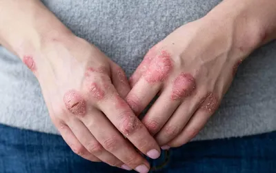 Уход за кожей при атопическом дерматите