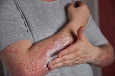 Атопический дерматит — симптомы, причины, лечение атопичной кожи
