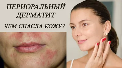 Лечение дерматита в Киеве — Derma.ua