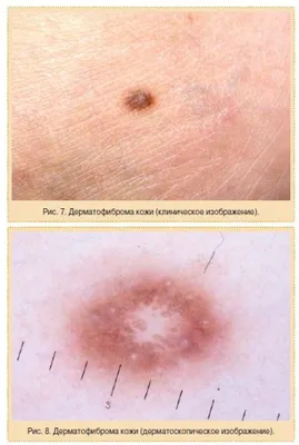Дерматофиброма кожи фото фото