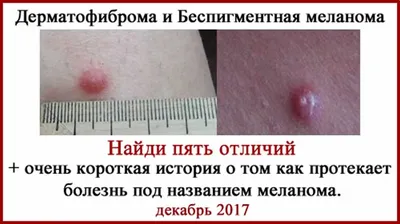 Дерматофиброма. Диагностика и лечение