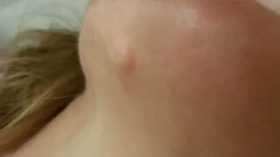 Удаление большой дерматофибромы кожи голени - YouTube