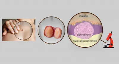 Удаление дерматофибромы лазером
