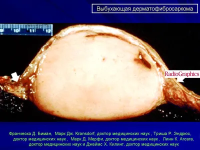 Dermatofibrosarcoma protuberans: Under the mask of scar - Vertieva -  Russian Journal of Skin and Venereal Diseases