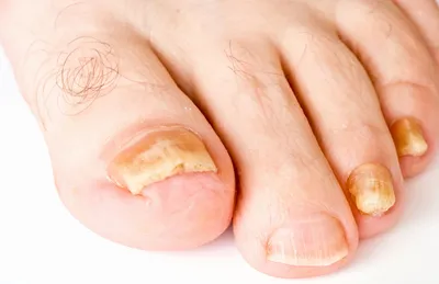 Лечение застарелого грибка ногтей | Клиника АЛОДЕРМ Москва