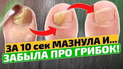 Грибок ногтей на ногах, лечение грибка ногтей в Днепре | Подо Центр Ольги  Пашиной