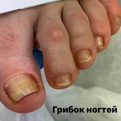 Step by Step - Онихомикоз -инфекция ногтей ,обычно обусловленная плесневым  грибком . 80%Дерматофиты.Поражают кожу и ногти. 15%Дрожжевые.Поражают в  основном слизистые 5%Плесневые грибки. Избався от грибка.Запишись на  консультацию ☎️💻📲 Консультация в ...