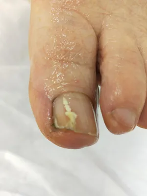 Медичний педикюр. Лікування вросших нігтей , мозолів, натоптишів -  Проявления грибка ногтей на ногах зависят от вида инфекции, а также от  степени и глубины поражения грибком. Перебравшись на ногтевую пластину,  дерматофиты, обычно