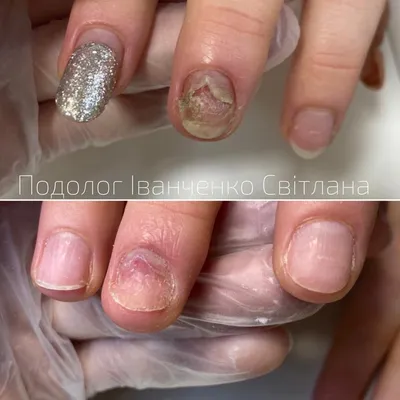 Грибок ногтей или онихомикоз | Описание заболевания - meds.ru