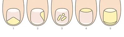Лечение грибка ногтей: причины заболевания, симптомы, классификация,  диагностика и лечение