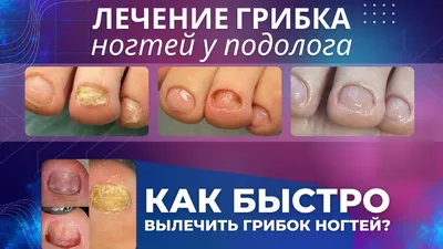 Лечение грибка ногтей (онихомикоза) на ногах и стопах в Рязани | Академия  клинической подологии