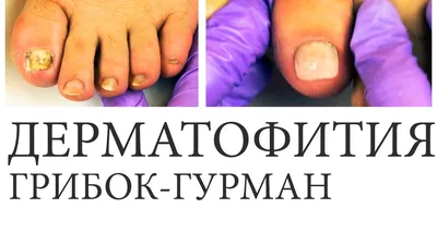 Чем чревато отсутствие лечения грибка ногтей — Медицинская лаборатория IMD
