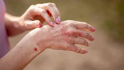 От чего появляются красные пятна на коже и чем они опасны | Evolutis Clinic  | Дзен
