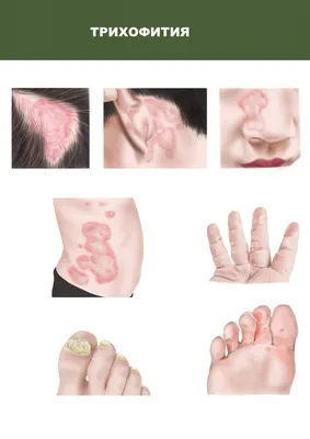 Дерматомикоз является грибковым заболеванием кожи. Этот недуг, извес