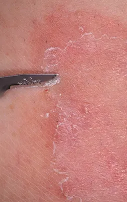 ДО И ПОСЛЕ | Микоз гладкой кожи Микоз гладкой кожи - это грибковая  инфекция, возбудителем которой являются микроскопические грибки. При… |  Instagram