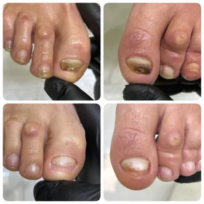 🍄Онихомикоз- грибковое заболевание ногтей, самая распространенная форма  дерматомикозов. Среди возбудителей самый частый - Красный… | Instagram