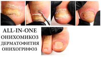 Лечение Грибка ногтей - Микоза / Центр педикюра и подологии на  Рокоссовского 24
