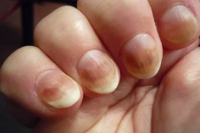 Лазерное лечение грибка ногтя в Харькове - Европейская дерматология