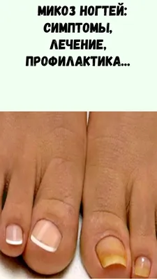 Грибок ногтей на ногах и руках: причины, первые признаки, основные  симптомы. Лечение онихомикоза в Москве