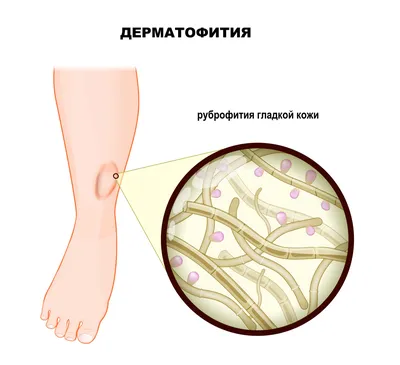 Грибковые заболевания кожи лица и головы: лечение, симптомы, фото, как  избавиться - Медицинский центр «Дезир» Санкт-Петербург.