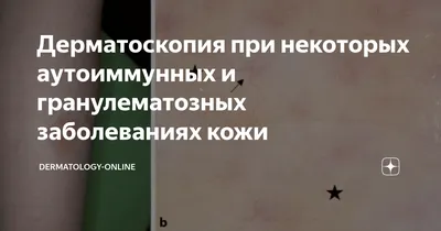 Дерматоскопия при меланоме кожи | meducate.ru — портал для врачей