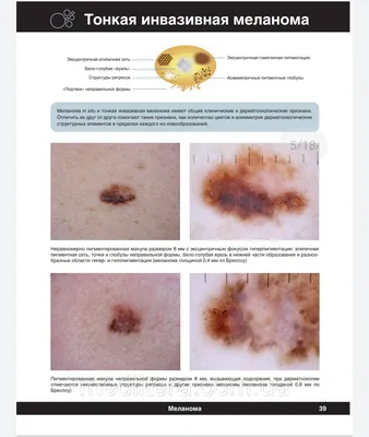 Дерматоскопия родинок и др. образований на коже, ранняя диагностика  меланомы в клинике лазерной хирургии «Градиент» в Москве